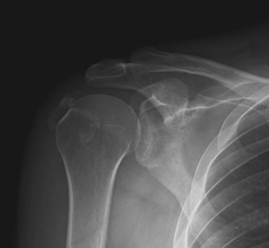 Ameliyat öncesinde röntgende omuzda kalsifik tendinit görüntüsü.