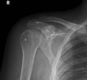 Ameliyat sonrasında çekilen röntgende omuzda kalsifik tendinit görüntüsü.