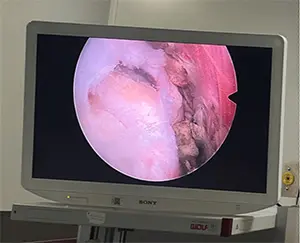 On the screen using an arthroscopic camera shoulder fiber tear displayed.