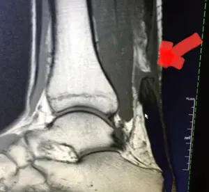 Aşil tendon kopması MR’da T2 görüntüsü.