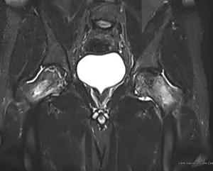 Avascular Necrosis Treatment