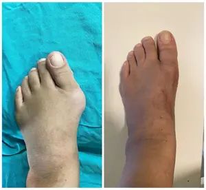 Ayak başparmak çıkıntısının ameliyat öncesi ve sonrası durumu şekilde görülmektedir.
