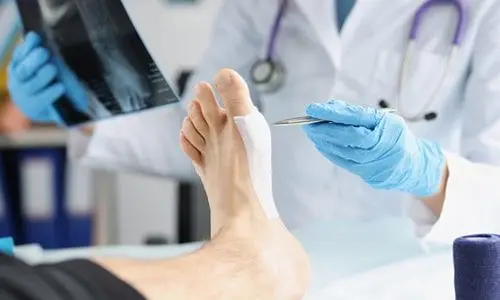 Ayak Başparmak Eğriliği (Halluks Valgus) Tanı ve Ameliyatı