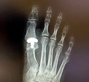 Ayak başparmak kireçlenmesi tedavisinde uygulanan yüzey artroplastisi ameliyatı AP X Ray görüntüsü