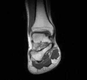Ayak bileği coronal MR T1 kesitinde talus dome medialinde osteokondral defekt (ocd).