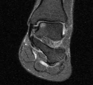 Ayak bileği coronal MR T2 kesitinde talus dome medialinde osteokondral defekt (ocd).