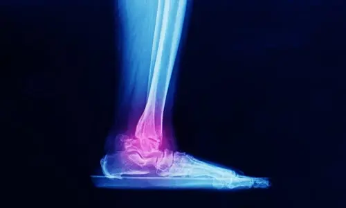 Ayak Bileği Kıkırdak Hasarı (Talus OCD) Ameliyatı Nedir?