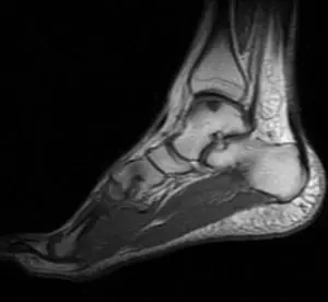 Ayak bileği sagittal MR T1 kesitinde talus domeda osteokondral defekt (ocd).