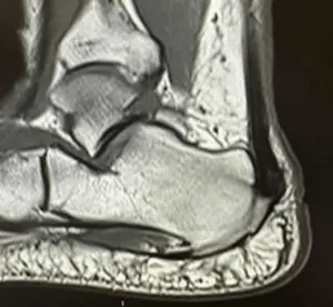 Ayak T1 sagittal MR kesitinde topuktaki (kalkaneus) kemik çıkıntının (Haglund deformitesi) aşil tendonunu sıkıştırması.