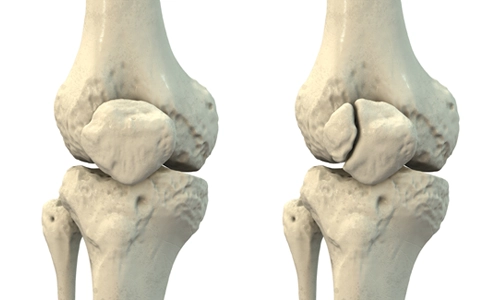 Bipartit Patella Nedir? Belirtileri, Tanısı ve Tedavisi