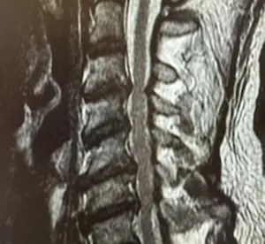 Boyun ağrısı nedeniyle MR görüntülemesi yapılan hastada: Boyun düzleşmesi; C3-C4, C4-C5, C5-C6, C6-C7 seviyelerinde geniş tabanlı disk protrüzyonu ve dural keseye bası.