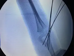Çocuk dirsek kırığının kapalı telleme yöntemi ile ameliyat edilmiş hali