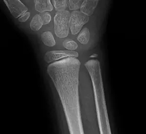 Çocuklarda görülen torus kırığı, önden çekilmiş röntgen görüntüsü.