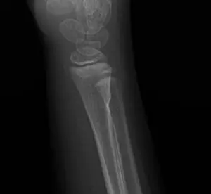 Çocuklarda görülen torus kırığı, yandan çekilmiş röntgen görüntüsü.