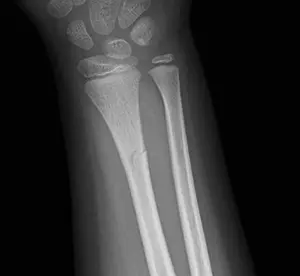 Çocuklarda görülen yaş ağaç kırığı, önden çekilmiş röntgen görüntüsü.