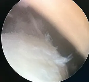 Diz kapağı çıkığı esnasında patellanın; diz eklemi kıkırdak yüzeyine verdiği hasarın artroskopi görüntüsü.