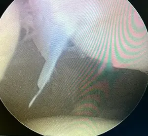 Diz kapağı çıkığı sonrası yaralanan MPFL bağı ve patella kıkırdağında gelişen hasarın artroskopi görüntüsü.