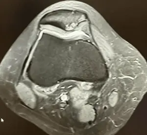 Kondromalaci patella discount