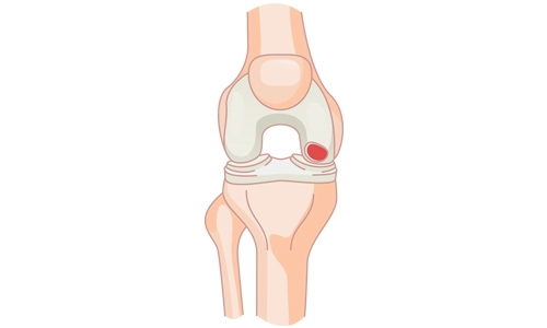 Eklem Faresi Nedir? Nedenleri, Belirtileri ve Tedavisi