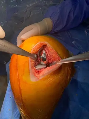 Femur medial kondilinde görülen ileri artroz sonrası uygulanan unikondiler diz protezi görüntüsü
