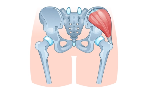 Gluteus Medius Yırtığı Nedir? Belirtileri, Tanı ve Tedavisi