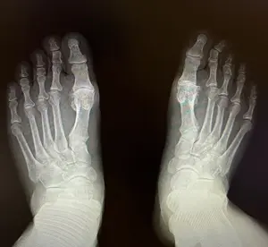 Her iki ayak başparmak ileri evre kireçlenmesi AP x ray görüntüsü