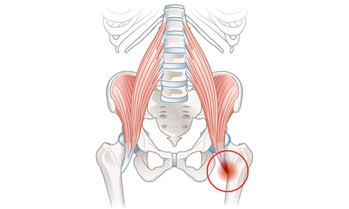 İliopsoas Tendiniti ve Bursiti Nedir? Tanısı ve Tedavisi