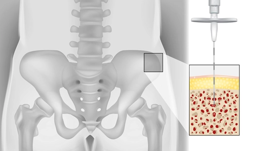 İntraosseöz Biyoplasti Nedir? Neden ve Nasıl Uygulanır?