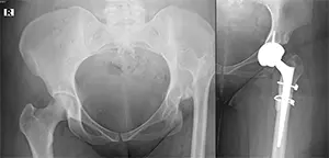 The patient had a 6 cm short leg length due to congenital hip dislocation. After hip replacement surgery, her leg length was lengthened by 6 cm and equalized.