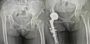 A different case with 6.5 cm shortness due to hip dislocation.