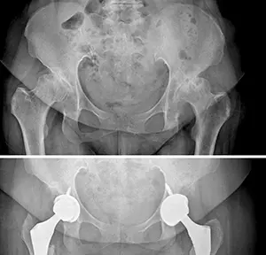 The patient who underwent hip prosthesis on both sides.