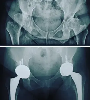 A different case of arthritis in which total hip prosthesis was applied to both hips.