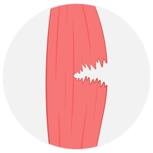 2. Derece Kas (Orta Derece) Yırtıkları 2. Derece Kas (Orta Derece) Yırtıkları