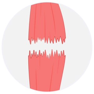 3. Derece Kas (İleri Evre) Yırtıkları 3. Derece Kas (İleri Evre) Yırtıkları