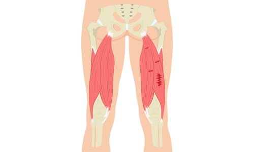 Kas Yırtılması Nedir? Kas Yırtığı Belirtileri ve Tedavisi