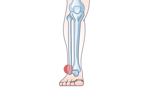 Kayakçı Ayak Bileği Yaralanması Nedir? Tanı ve Tedavisi