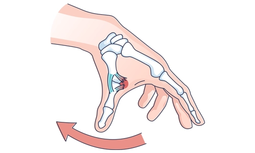 Kayakçı Başparmağı Nedir? Belirtileri, Tanısı ve Tedavisi