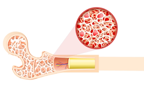Kemik İliği Ödemi Nedir? Nedenleri, Belirtileri ve Tedavisi