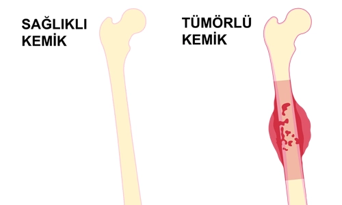 Kemik Metastazı (Metastatik Kemik Tümörü) Belirtileri ve Tedavisi