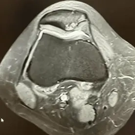 Kondromalazi Patella MR