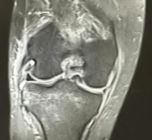 Koronal kesit T2 Diz MR’da iç menisküste Kova sapı menisküs yırtığı izlenmekte.