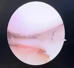Kova sapı menisküs yırtığında eklem içine sıkışan menisküsün, artroskopi ameliyatı ile yerine oturtularak dikişler ile tamir edilmesi.