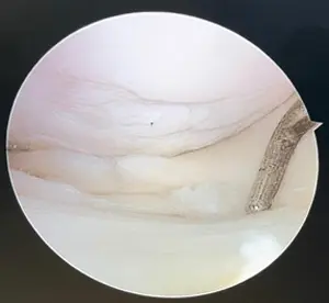Kova sapı menisküs yırtığında eklem içine sıkışan menisküsün, artroskopi görüntüsü.