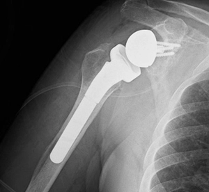 Kronik omuz çıkığı olan ileri yaş hastaya uygulanan ters omuz protezi röntgen görüntüsü.