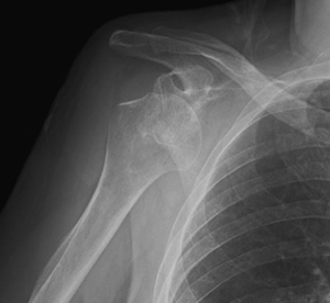 Kronik omuz çıkığına bağlı omuz yuvasında ileri derecede aşınma ve tekrarlayan omuz çıkıkları olan ileri yaş hastanın röntgen görüntüsü.