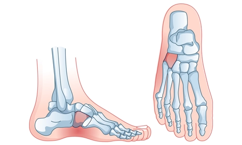 Küboid Sendromu Nedir? Nedenleri, Tanısı ve Tedavisi