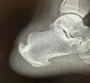 Lateral ayak filminde izlenen haglund deformitesi hastalığı.