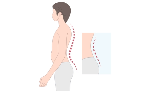 Lordoz Nedir? Belirtileri ve Tedavisi