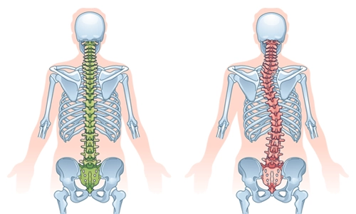 McCune Albright Sendromu Nedir? Ortopedik Sorunları?