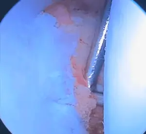 Omuz bankart lezyonu artroskopik bankart tamiri sonrası artroskopi ameliyat içi görüntüsü.